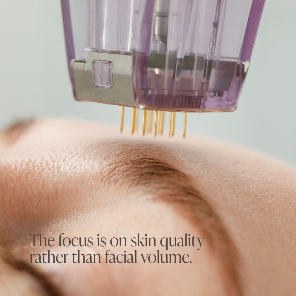Post-summer skin reset with microneedling and polynucleotides in Ramsbottom